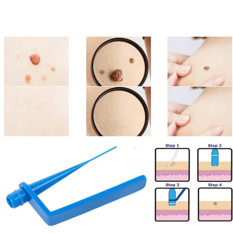 Kit de eliminación de marcas de piel, herramientas de tratamiento con hisopos de limpieza, eliminador de verrugas y lunares.